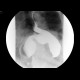 Diaphraghmatic hernia, Bochdalek hernia: RF - Fluoroscopy